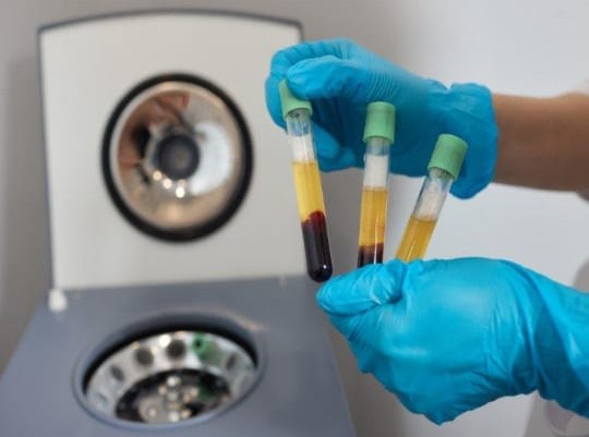 Centrifuged blood tubes separated for PRP