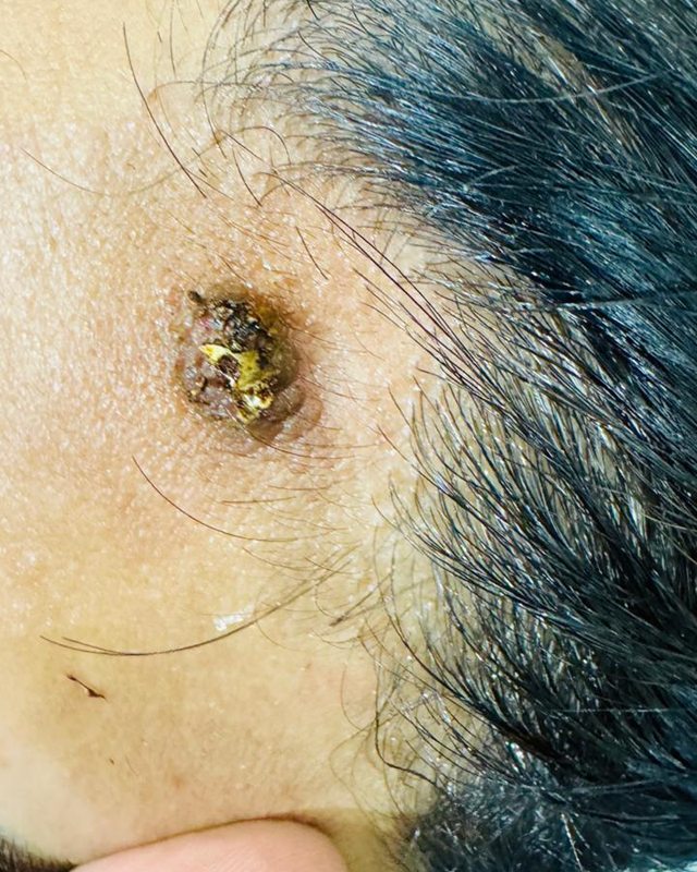 Before treatment: the patient's temple