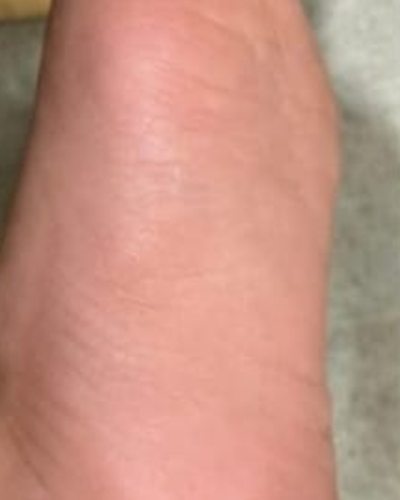After treatment: the sole of the patient's foot