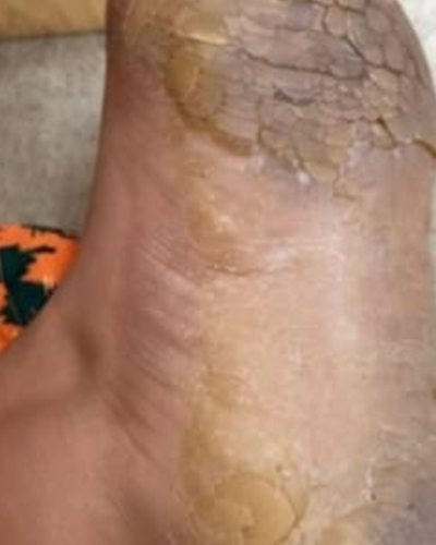 Before treatment: the sole of the patient's foot