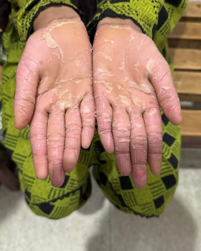 After treatment: the patient's palms