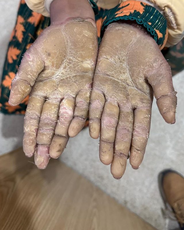 Before treatment: the patient's palms