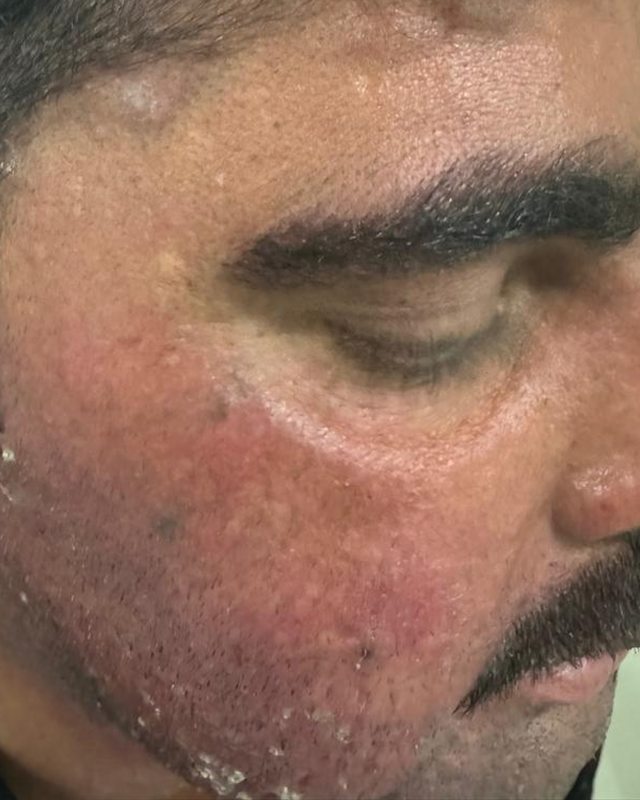 After treatment: the patient's cheek and jaw